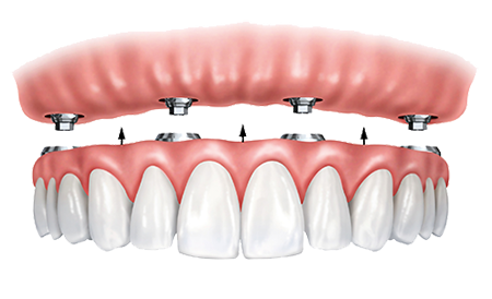 All-On-4®; Dental Implants