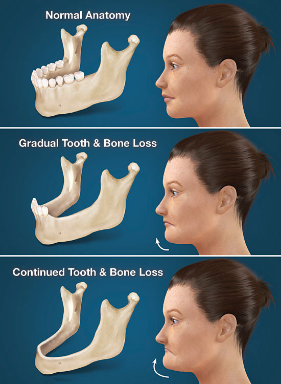 Consequences of tooth loss
