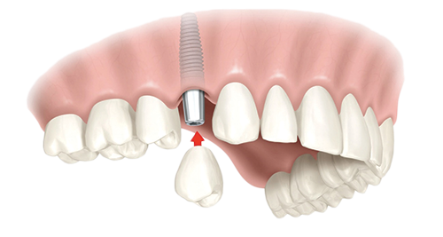 Single Dental Implants Decatur