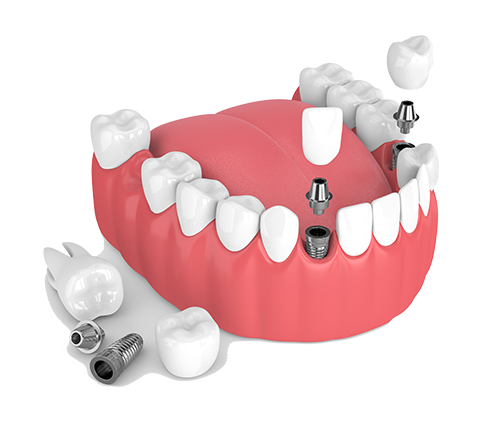Multiple Teeth Dental Implants in Decatur